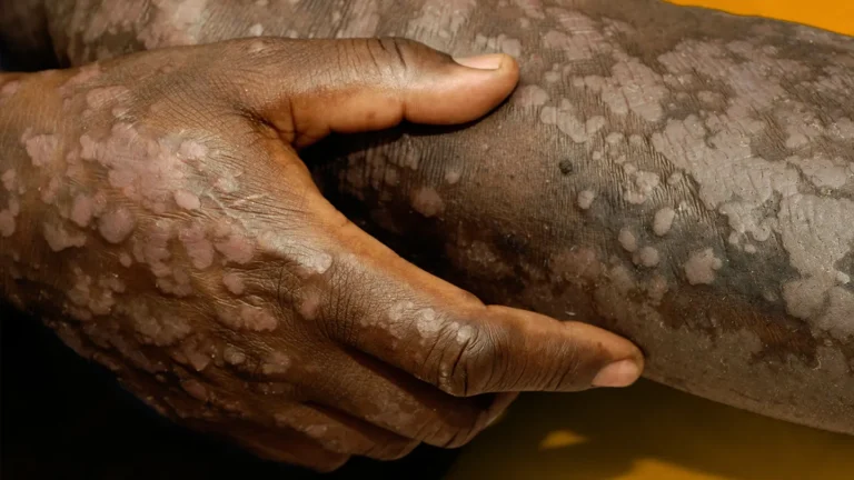Nilihangaika na Vidonda na Magonjwa ya Ngozi kwa Miaka Mingi Bila Tiba Hospitalini, Mpaka Mitishamba ya Kienyeji Iliponiponya